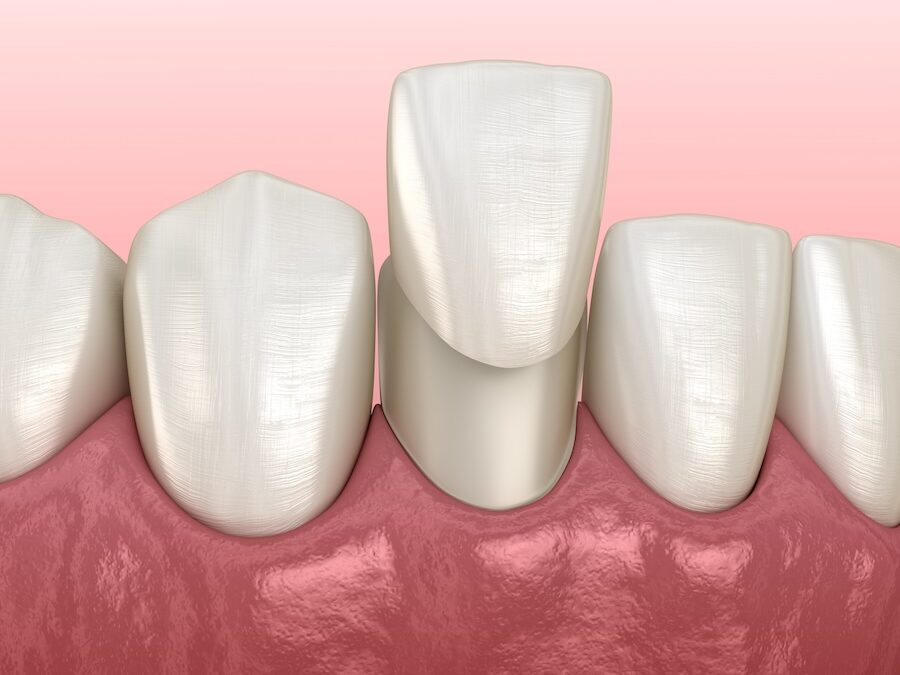 Finding Your Perfect Smile: Dental Bonding vs Veneers